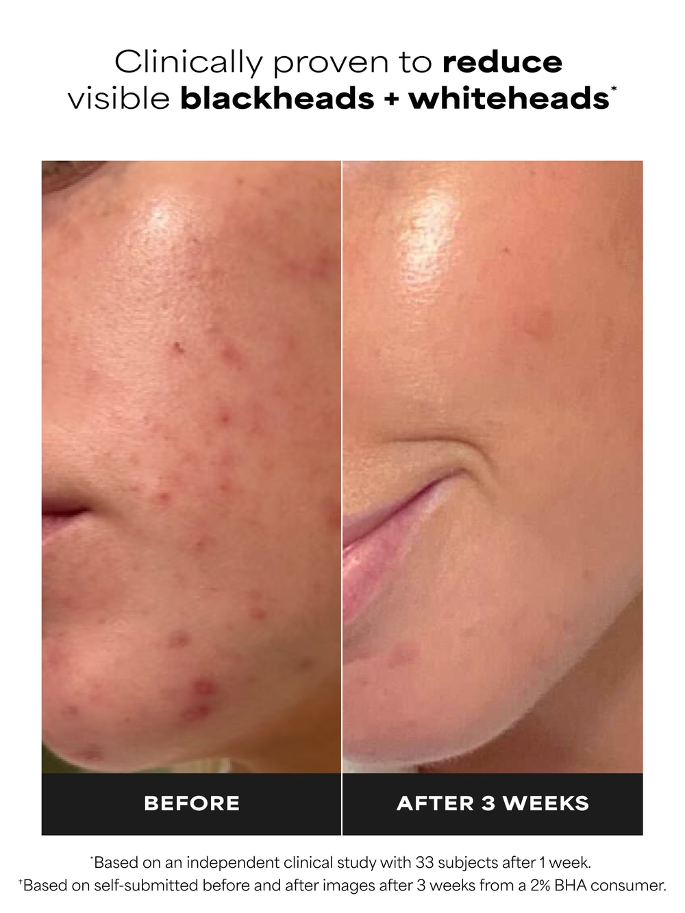 Paula's Choice 2% BHA Liquid Exfoliant